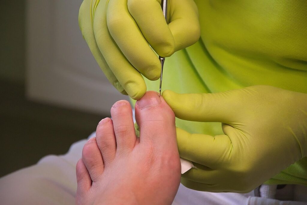 bumble foot treatment for chickens